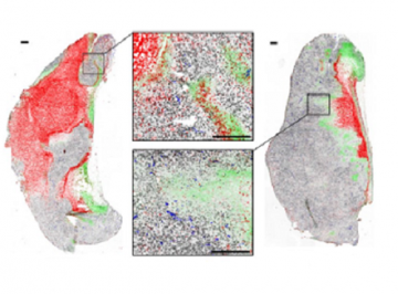 Karsan Lab Reveals a Novel Promoter of Tumorigenesis